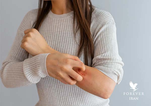 حساسیت پوستی